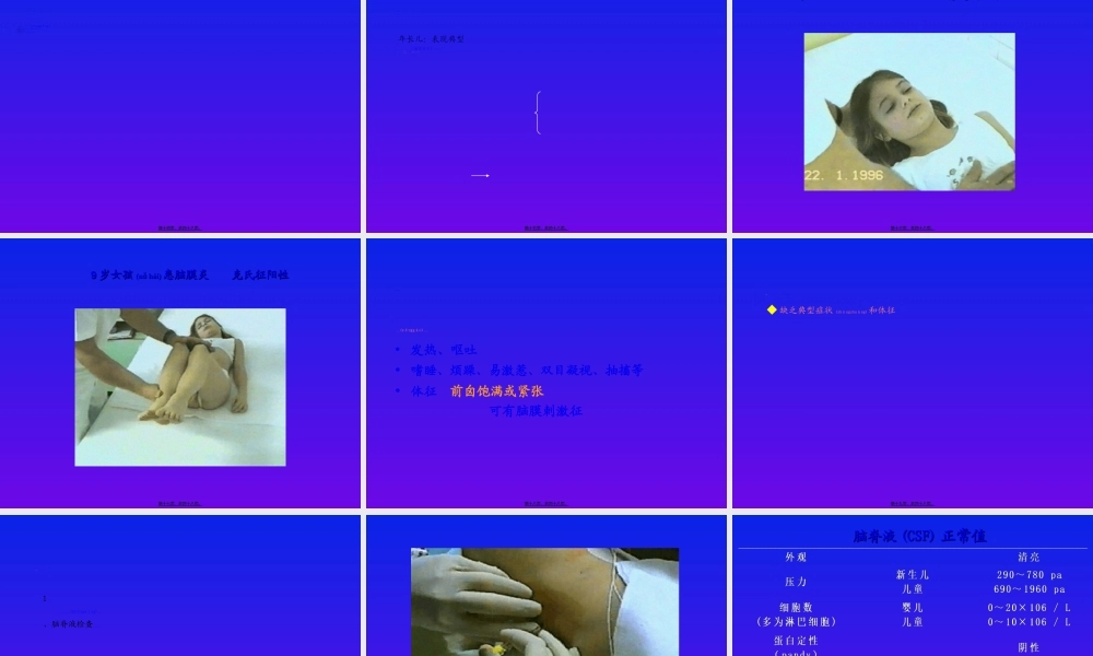 2022年医学专题—化脓性脑膜炎修改-PPT文档资料.ppt