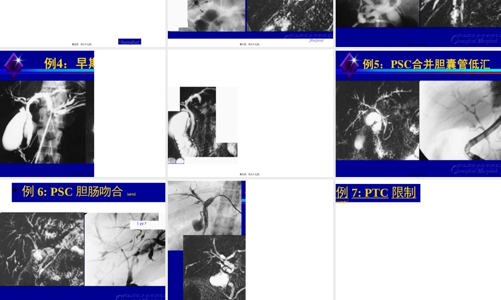 2022年医学专题—原发性硬化性胆管炎.pptx