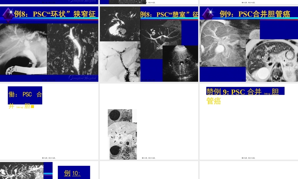 2022年医学专题—原发性硬化性胆管炎.pptx