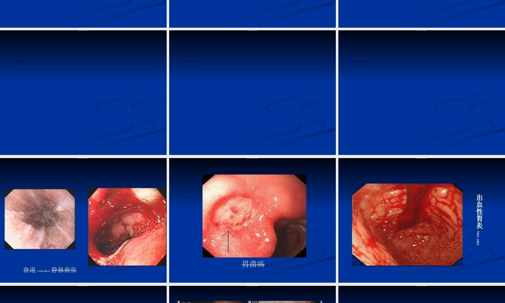 2022年医学专题—呕血与便血-2.ppt