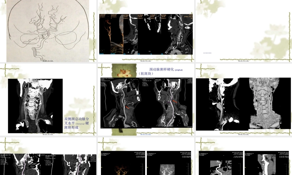 2022年医学专题—头颈部CTA.ppt