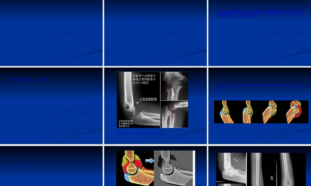 2022年医学专题—影像学检查在骨创伤中的应用.ppt