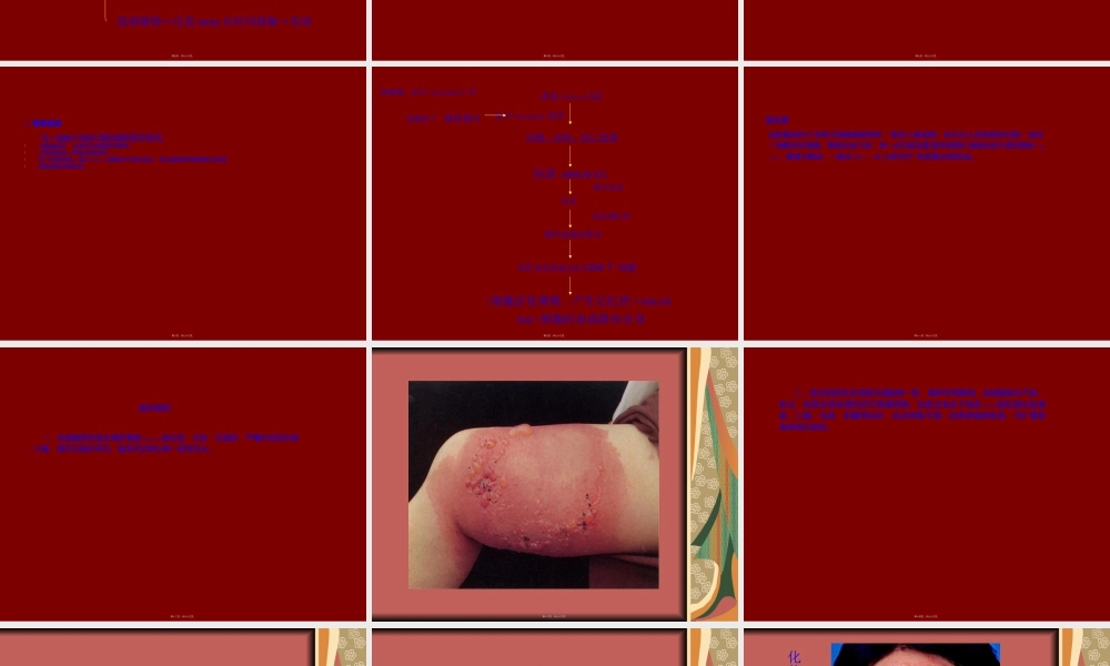 2022年医学专题—皮炎与湿疹.ppt