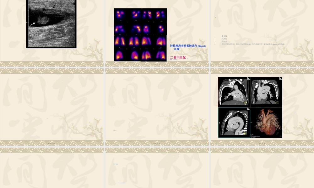 2022年医学专题—肺动脉栓塞CTPA修改.ppt