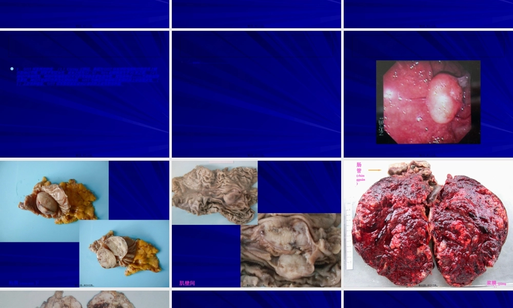 2022年医学专题—胃肠间质瘤剖析.ppt