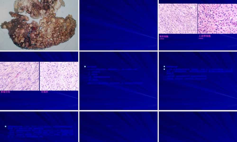 2022年医学专题—胃肠间质瘤剖析.ppt
