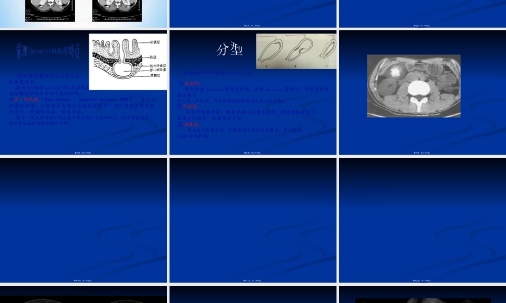 2022年医学专题—胆囊腺肌增生症.ppt