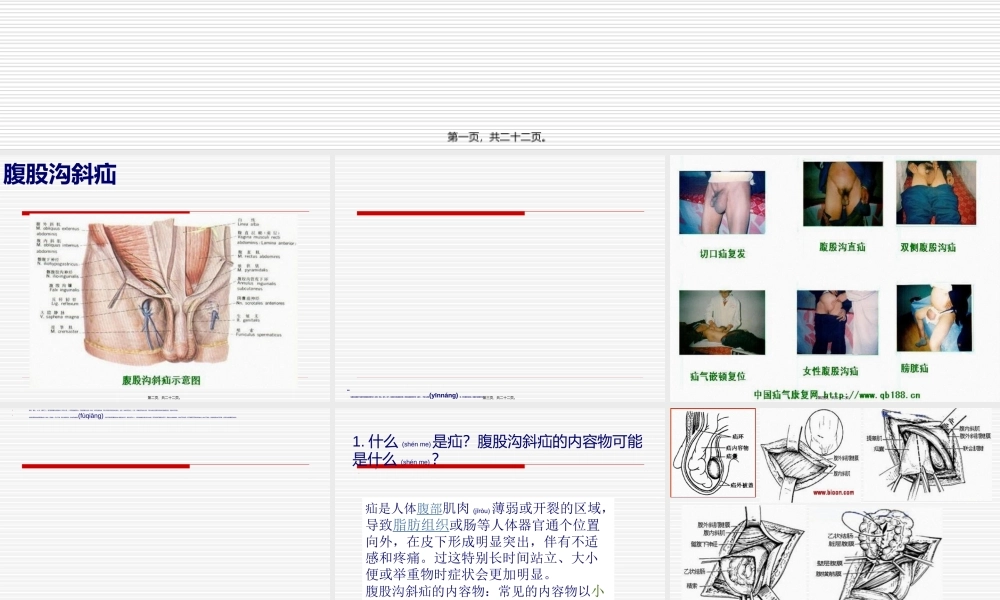 2022年医学专题—腹股沟斜疝.ppt