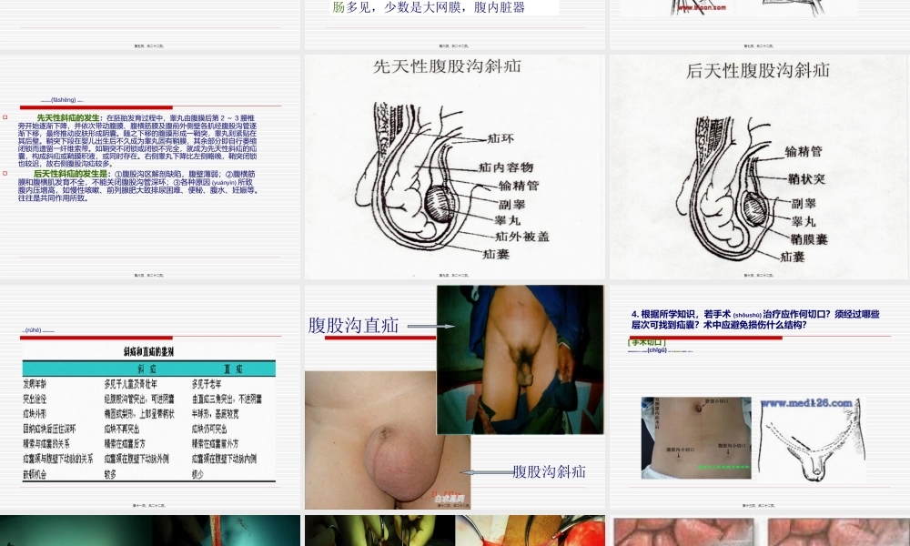 2022年医学专题—腹股沟斜疝.ppt