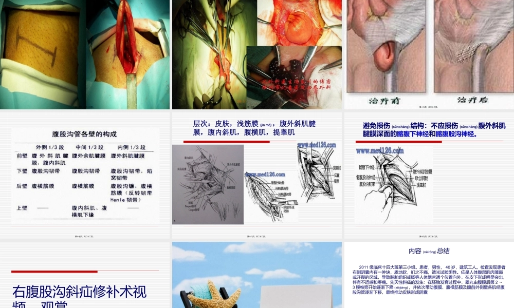 2022年医学专题—腹股沟斜疝.ppt