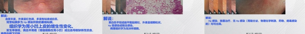 京都胃炎分类探析.ppt