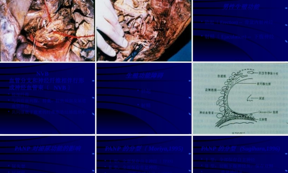 保留神经直肠癌根治术讲解.pptx