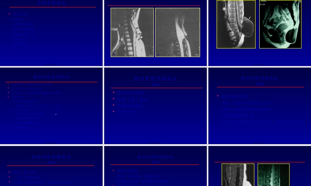 先天性脊柱闭合不全性病变MRI.pptx