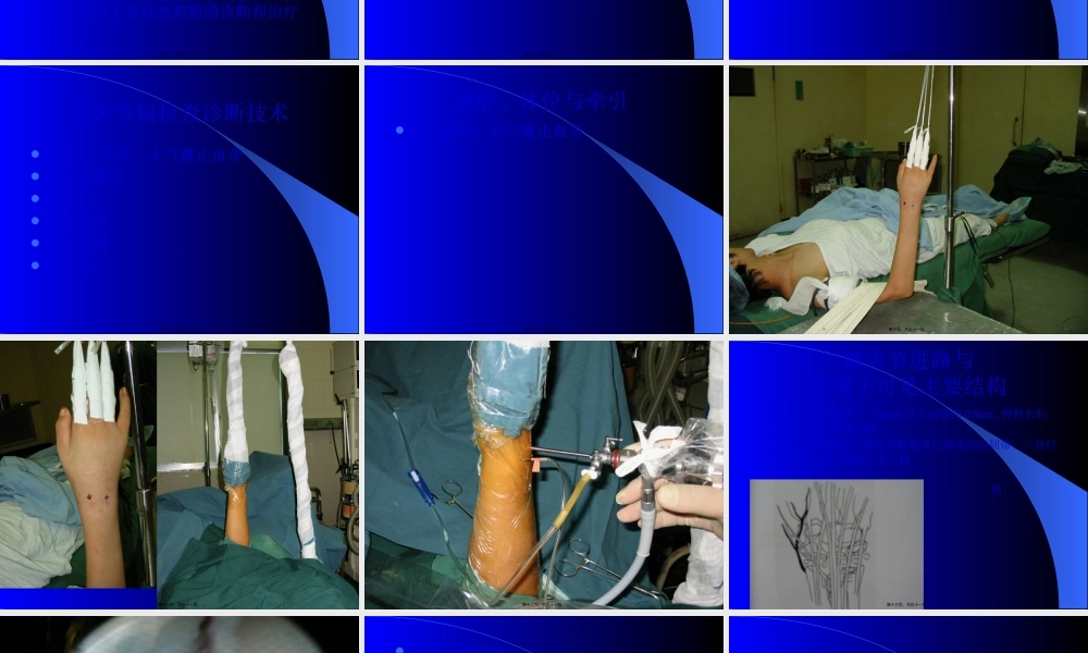 内窥镜在手外科的应用.pptx