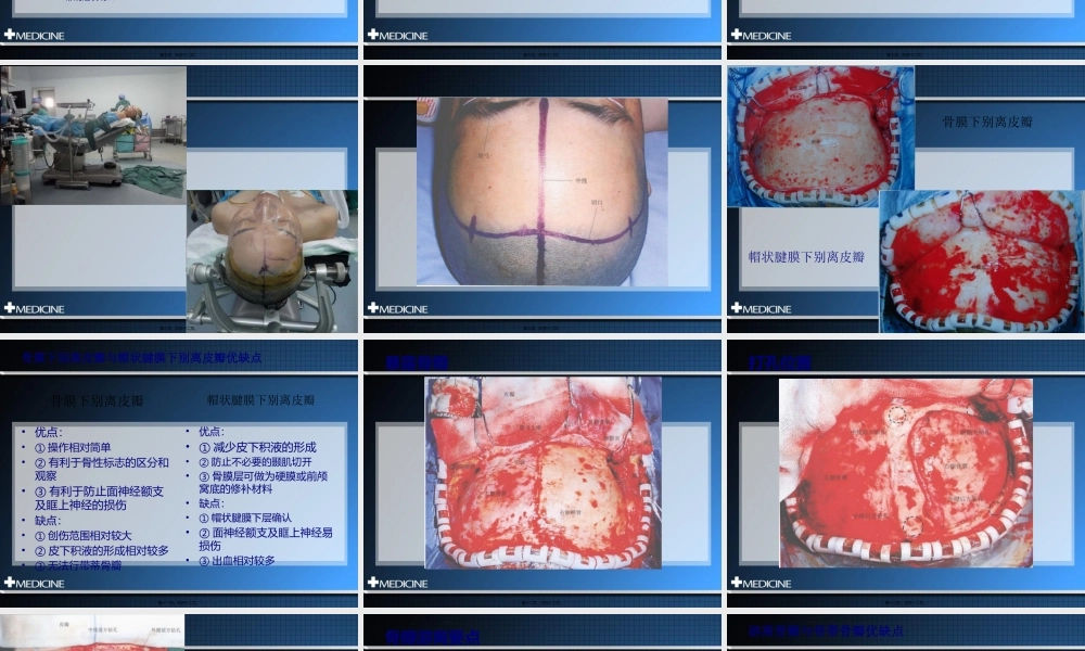 冠切开颅额下入路.pptx
