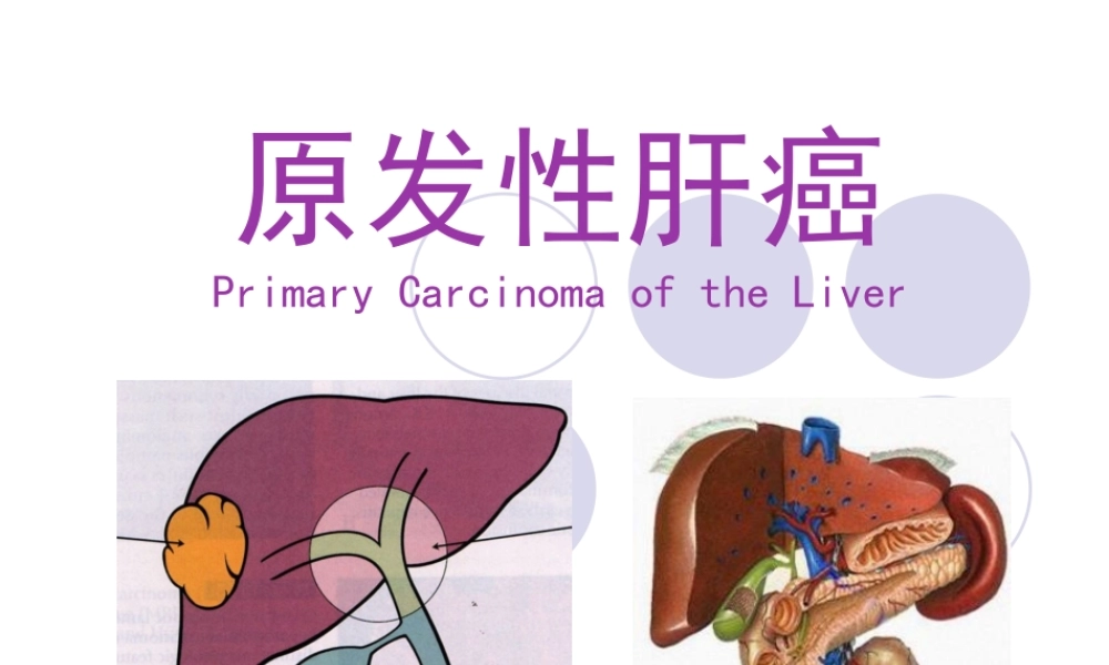 原发性肝癌-俞.pptx