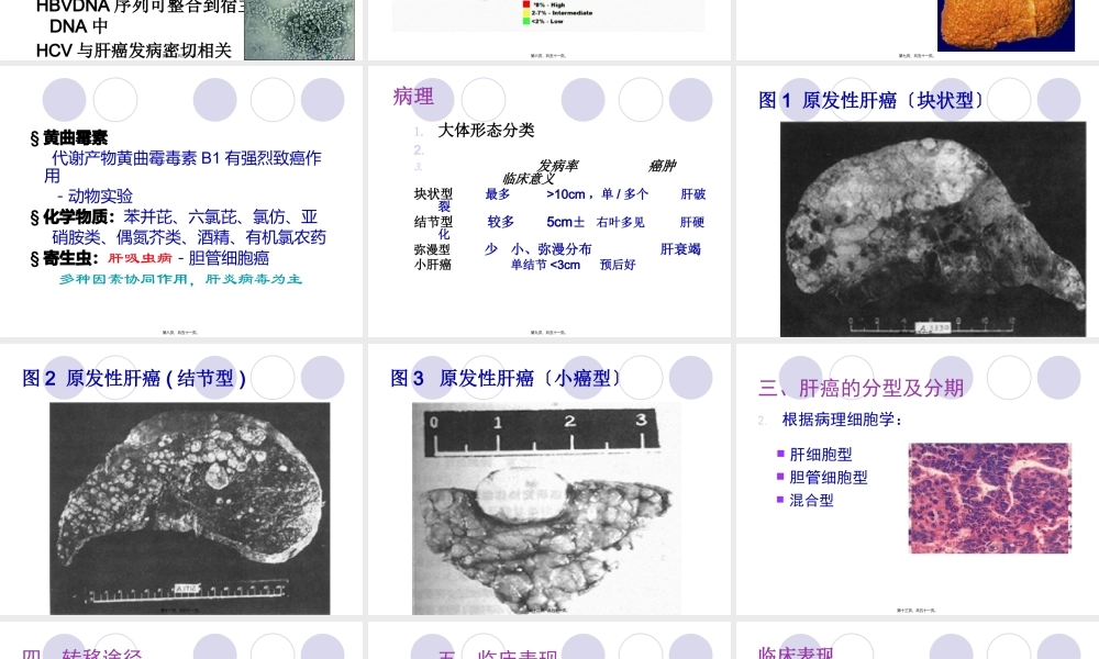 原发性肝癌-俞.pptx