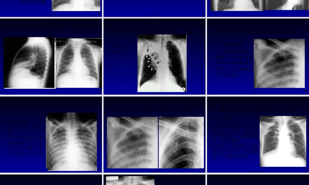 呼吸系统基本病变3.pptx