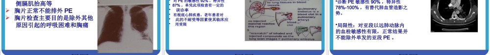 大面积肺栓塞与急性右心功能不全.pptx