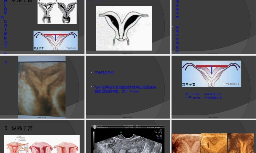 子宫畸形及三维成像.pptx