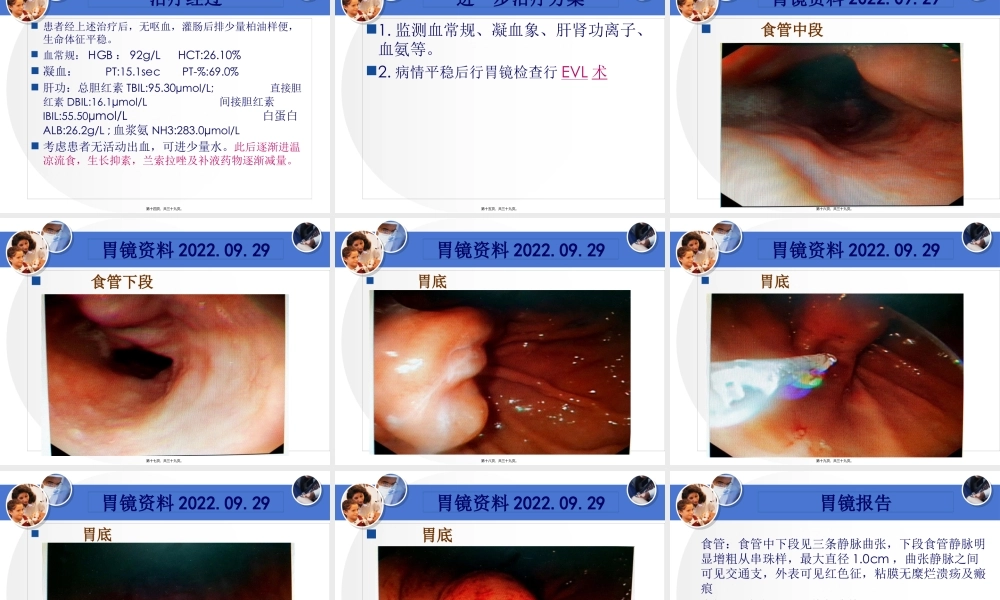 孙XX-肝硬化病例讨论.pptx