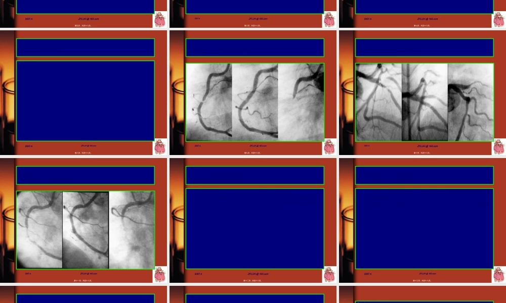 2022年医学专题—冠脉支架内血栓的防治策略.ppt