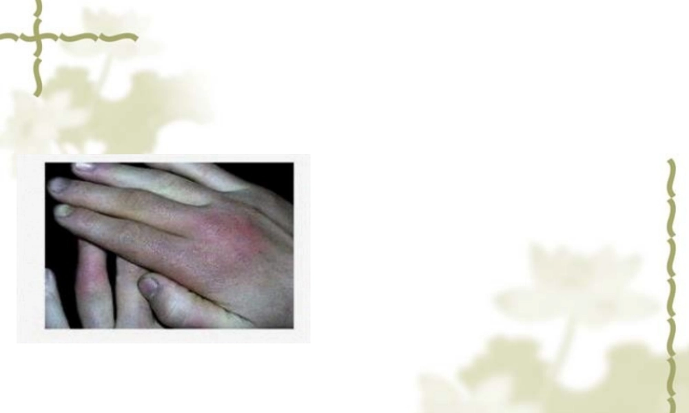 2022年医学专题—冷伤.ppt