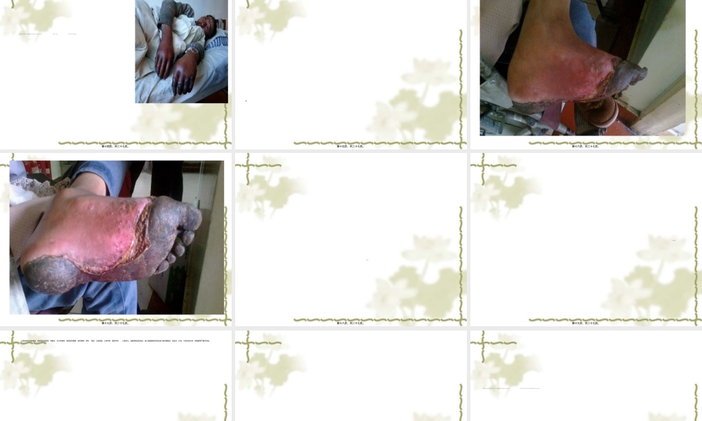 2022年医学专题—冷伤.ppt