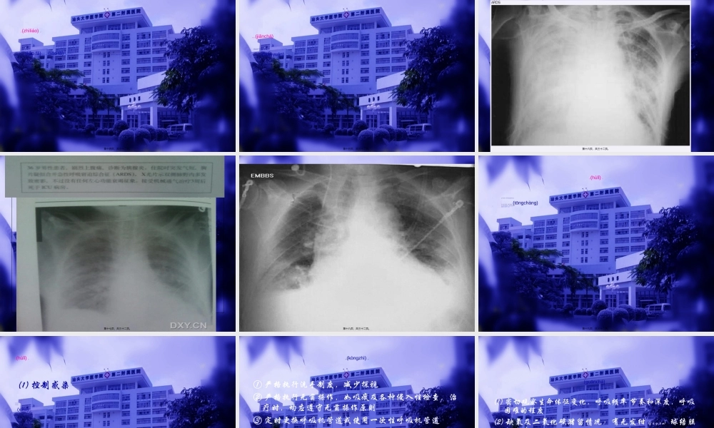 2022年医学专题—急性呼吸窘迫综合(1).ppt