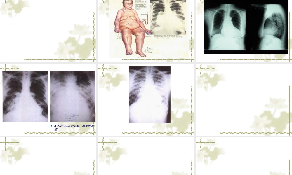 2022年医学专题—急性左心衰(1).ppt