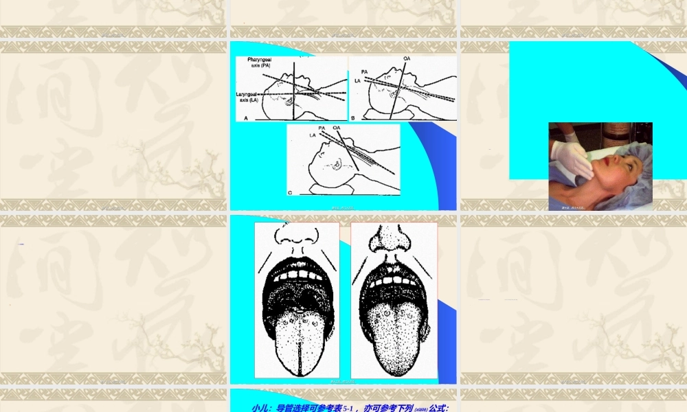 2022年医学专题—气管插管术及并发症防治(1).ppt