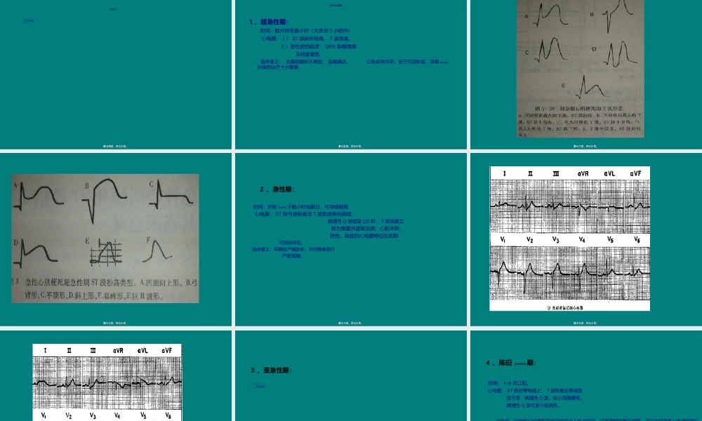2022年医学专题—冠心病的心电图表现#.ppt