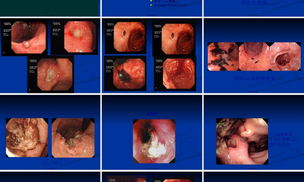2022年医学专题—急性非静脉曲张性上消化道出血内镜下诊治进展定.ppt
