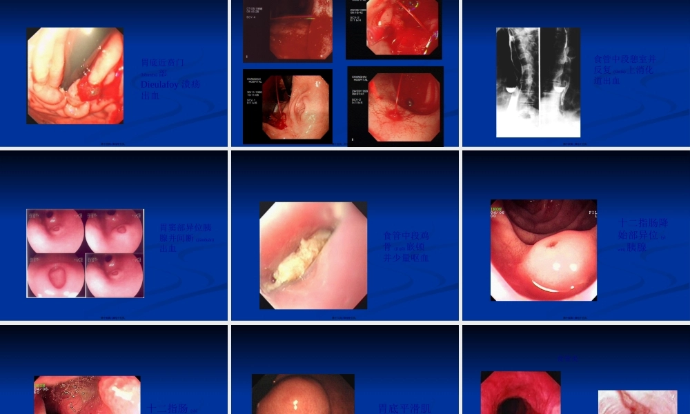 2022年医学专题—急性非静脉曲张性上消化道出血内镜下诊治进展定.ppt
