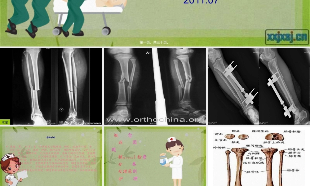 2022年医学专题—胫腓骨骨折.ppt