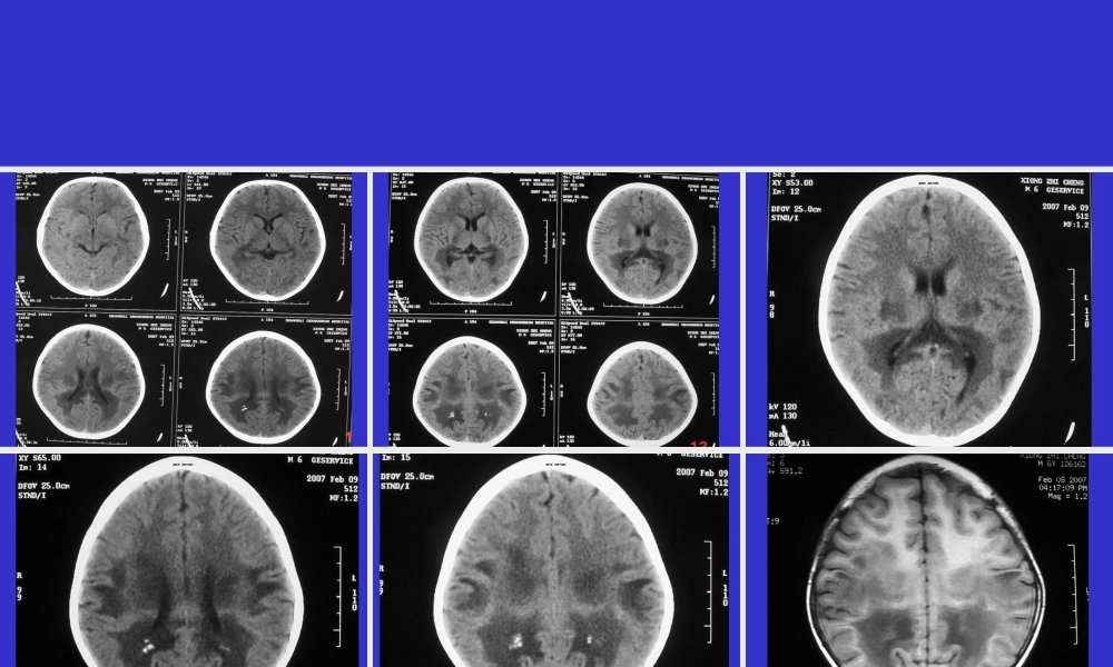 2022年医学专题—常见脑白质病——影像(1).ppt