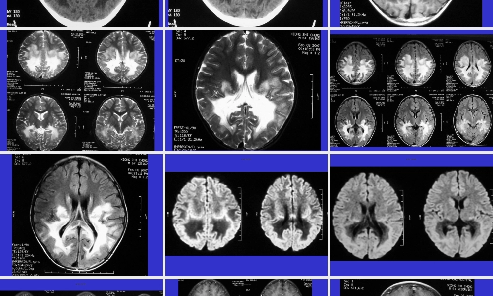 2022年医学专题—常见脑白质病——影像(1).ppt