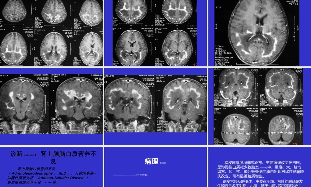 2022年医学专题—常见脑白质病——影像(1).ppt