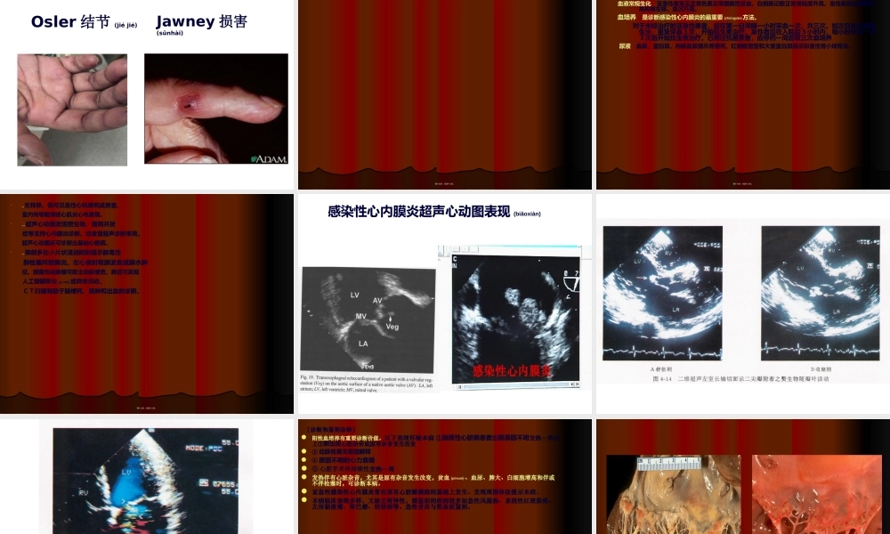 2022年医学专题—感染性心内膜炎心肌炎.ppt