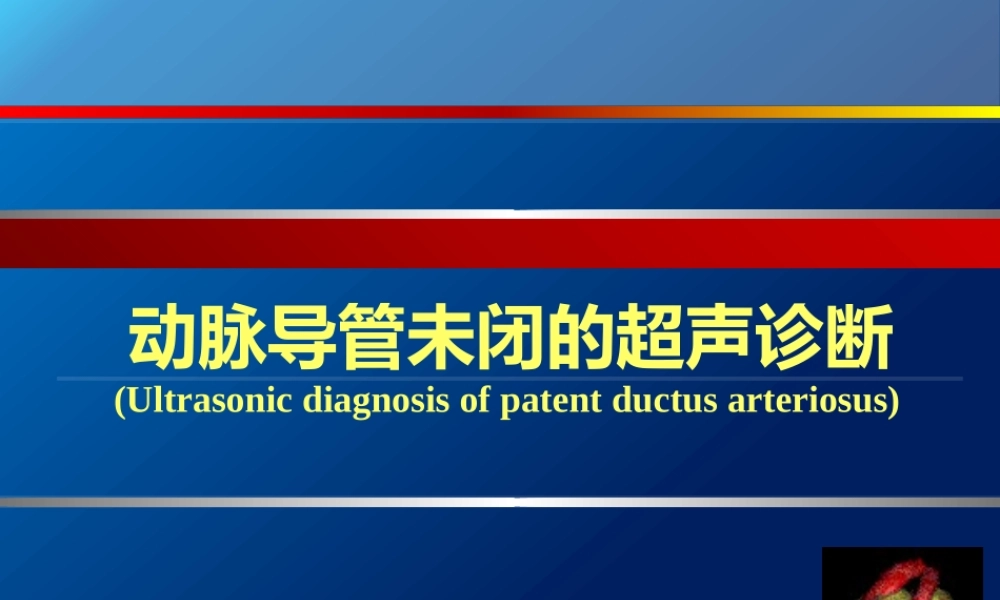 动脉导管未闭、主动脉狭窄.pptx