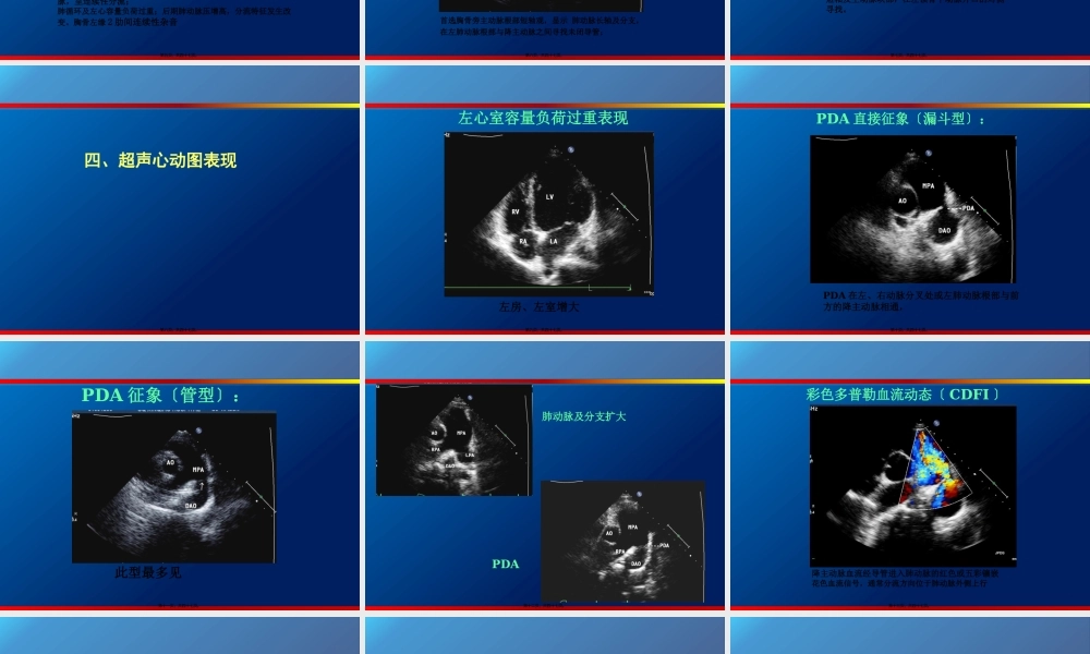 动脉导管未闭、主动脉狭窄.pptx