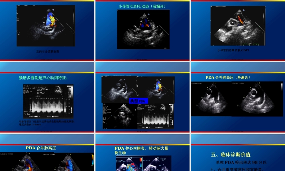 动脉导管未闭、主动脉狭窄.pptx