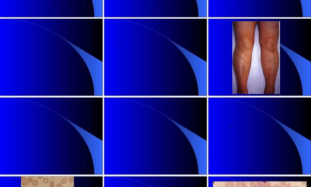 2022年医学专题—特-发-性-血-小-板-减-少.ppt