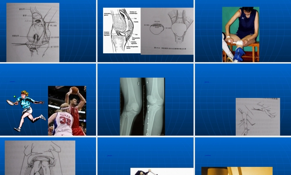 2022年医学专题—胡超华--膝关节运动创伤(1).ppt