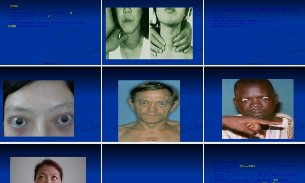 2022年医学专题—弥漫性甲状腺肿伴功能亢进症汇编.ppt