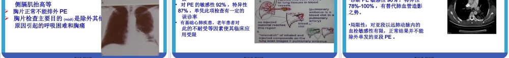 2022年医学专题—大面积肺栓塞与急性右心功能不全.ppt
