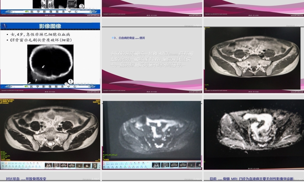 2022年医学专题—浅谈白血病骨质改变(1).ppt