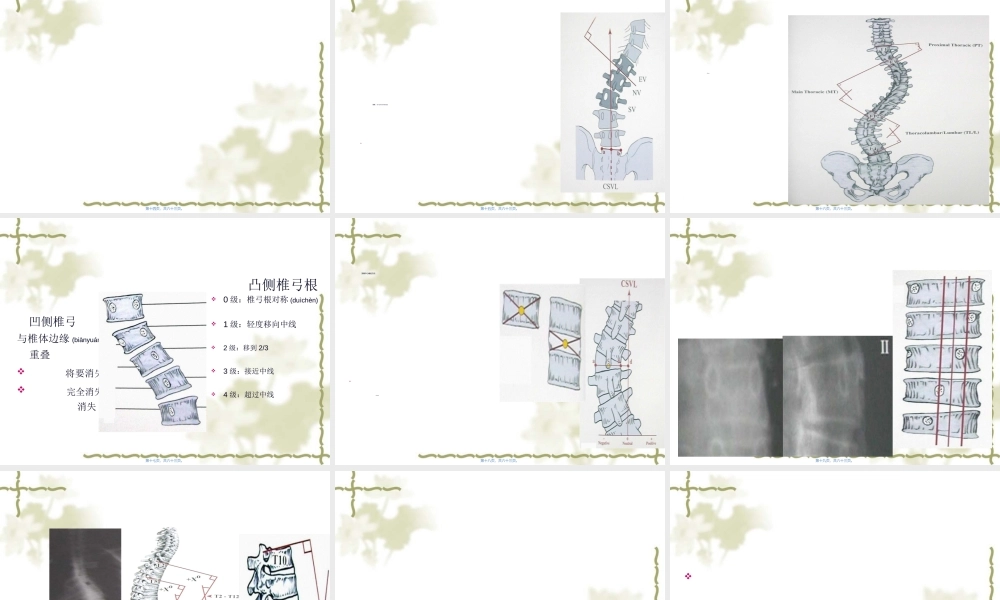 2022年医学专题—脊柱侧凸症的手法矫正(1).ppt