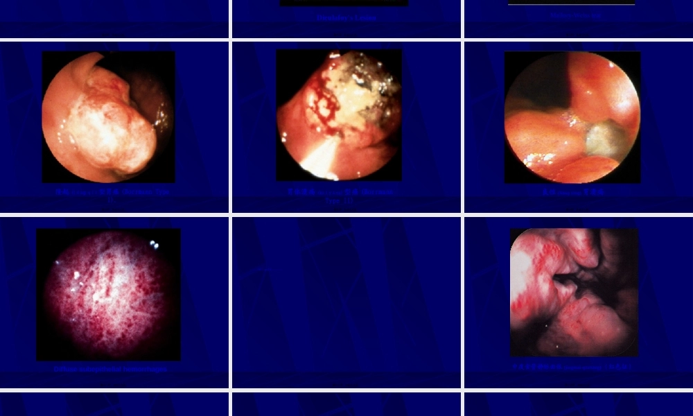 2022年医学专题—其上的消化道出血称上消化道出血其下的消化道出血称为下消化道出血(1).ppt