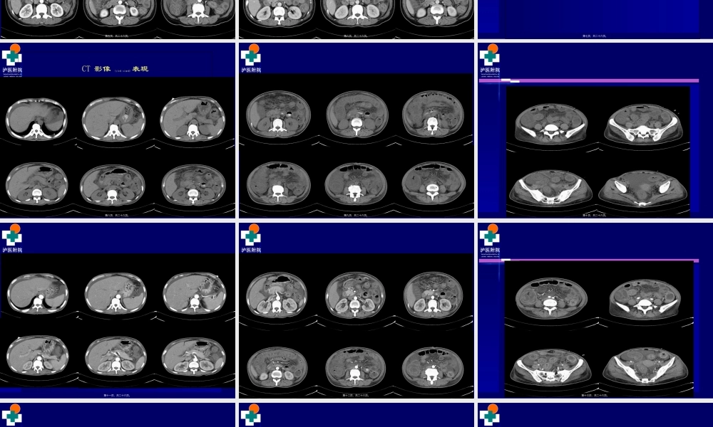 2022年医学专题—系统性红斑狼疮-病例.ppt